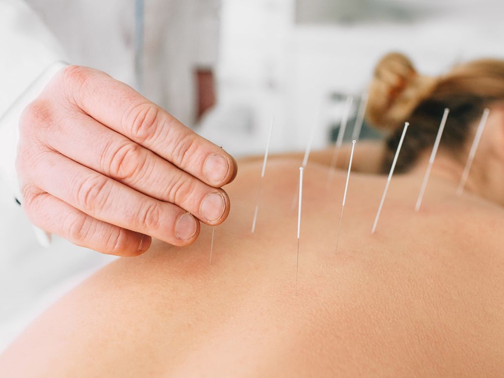 acupuncture on upper back