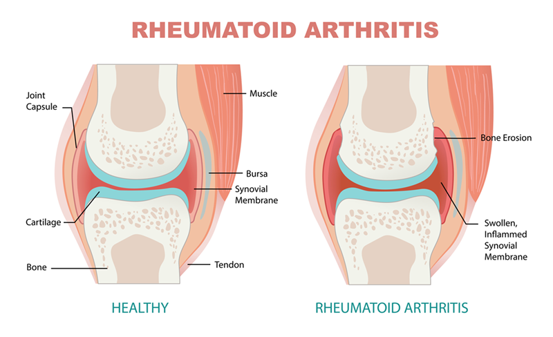 rheumatoid arthritis