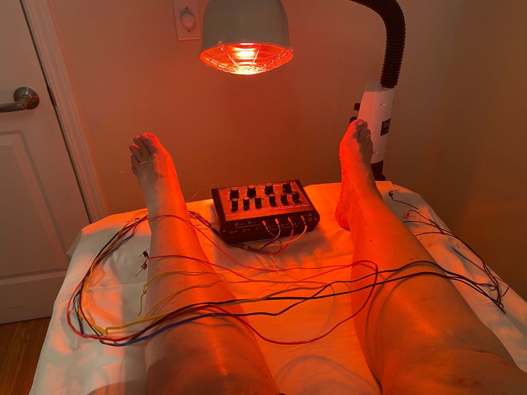 Acupuncture & electroacupuncture in neuropathy